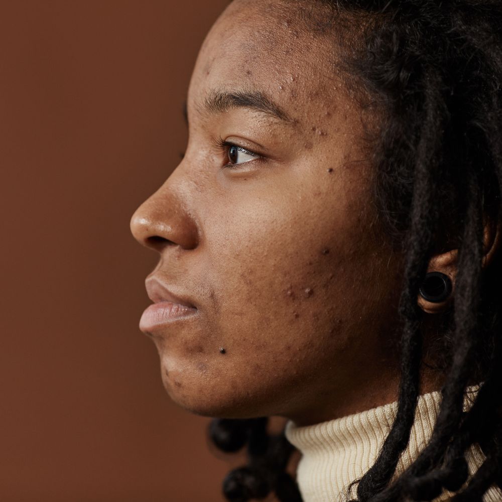 Comprendre l’acné hormonale pour mieux la traiter